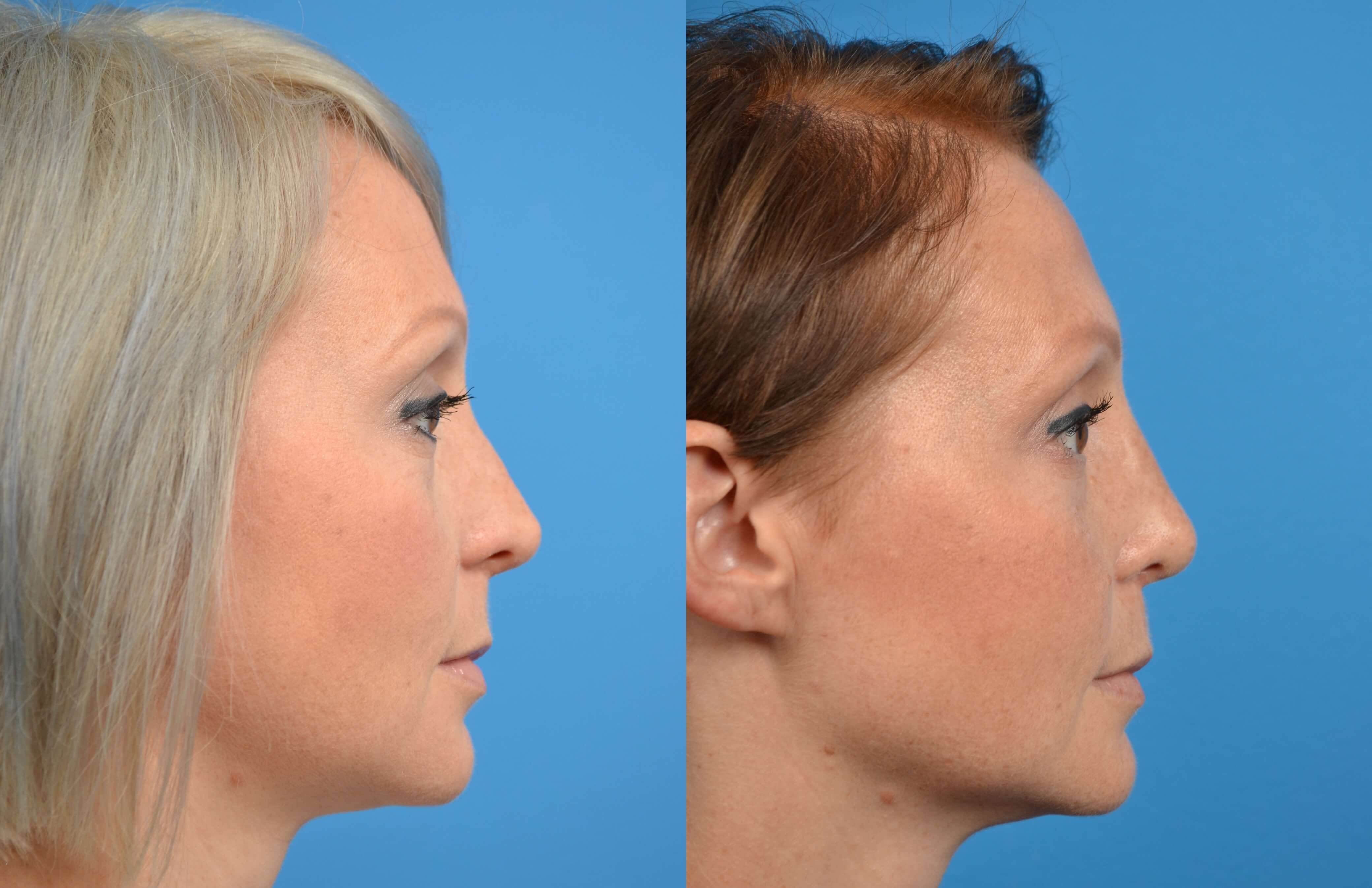 Rhinoplasty Photos Melbourne, FL Patient 16738